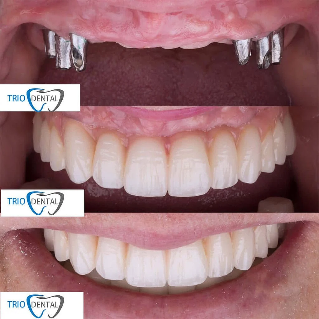 I Benefici degli Impianti Dentali Albania per un Impianto Dentario Affidabile e Duraturo