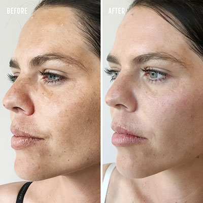 Common Myths and Facts About Laser Pigmentation Treatment