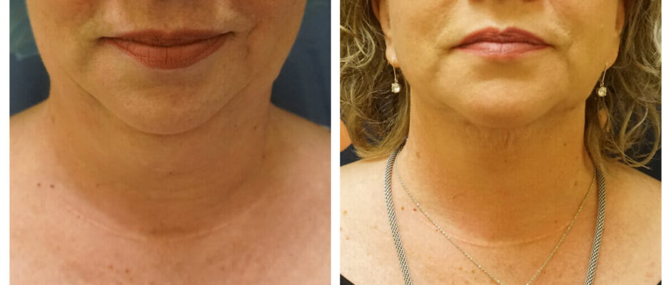 Neck Liposuction