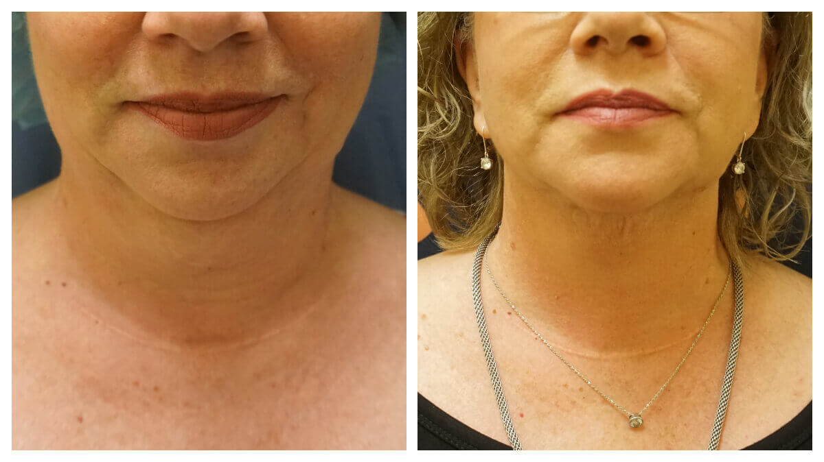 Is Neck Liposuction a Permanent Solution to Neck Fat?