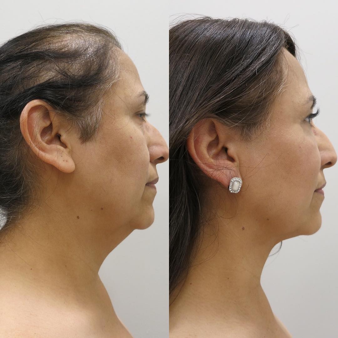 What Are the Benefits of Neck Liposuction Over Other Procedures?