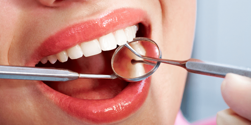 impacted wisdom teeth