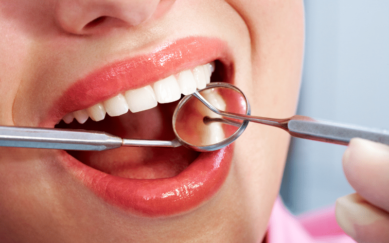 impacted wisdom teeth