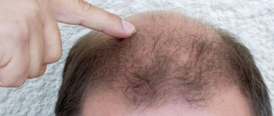 What Experts Say About 1 Dirham Hair Transplant?