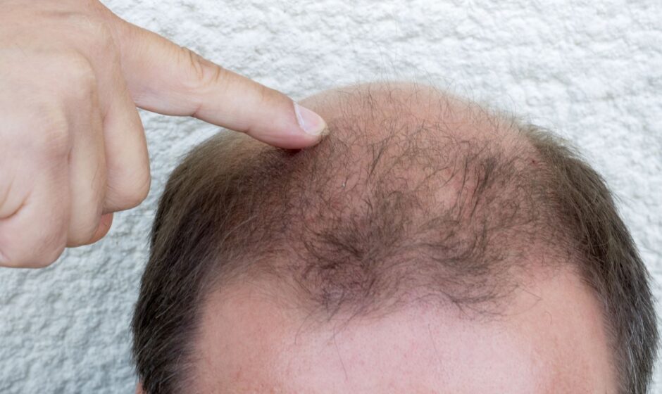 What Experts Say About 1 Dirham Hair Transplant?