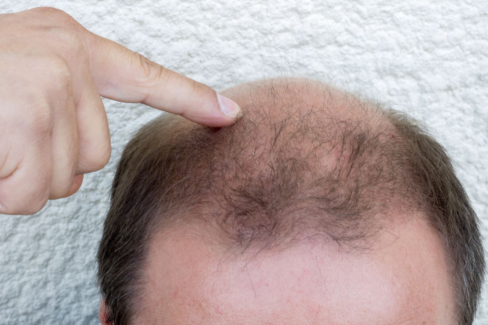 What Experts Say About 1 Dirham Hair Transplant?