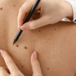 What Kind of Doctor Should You Consult for Varicose Veins?