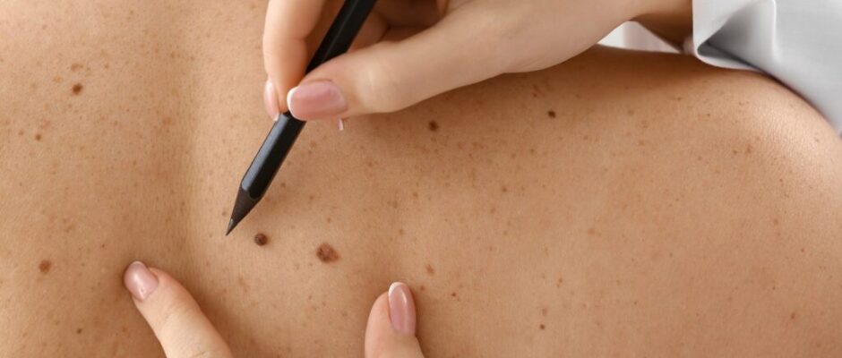 What Is the Safest Mole Removal Treatment Method?