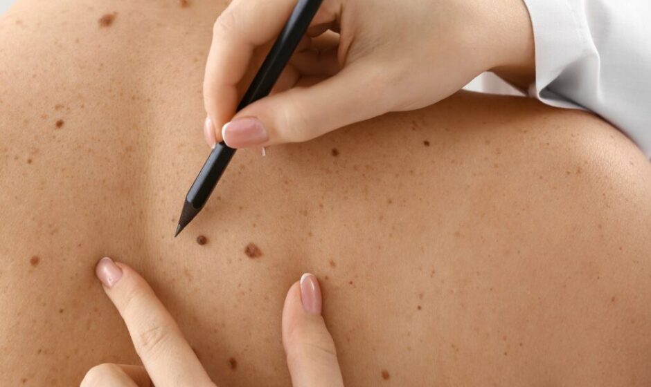 What Is the Safest Mole Removal Treatment Method?