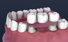 Dental Crowns & Bridges in Goregaon, Mumbai