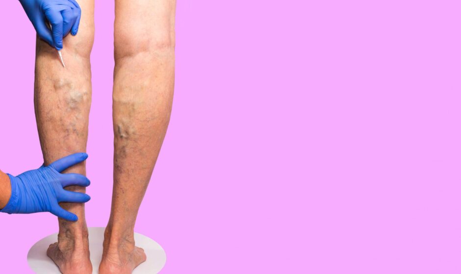 When to see a Vascular Doctor