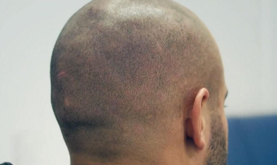 How Hair Replacement Gives Instant Results