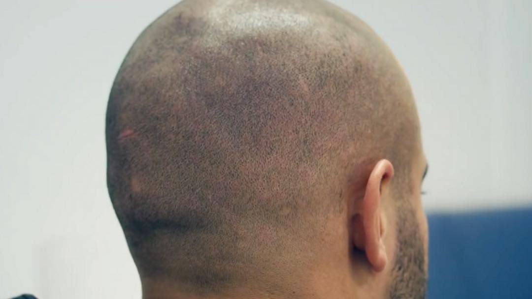 How Hair Replacement Gives Instant Results