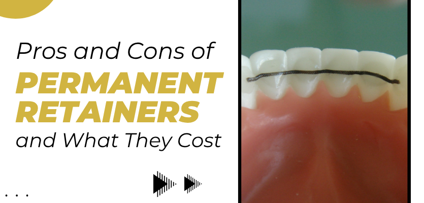 permanent retainer in London